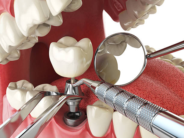 Best Emergency Wisdom Teeth Removal in Lone Tree, IA